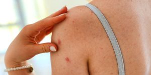 thuốc trị viêm nang lông tốt nhất