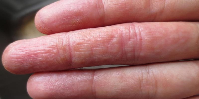 Tổ đỉa ở tay chân là gì? Có lây không?