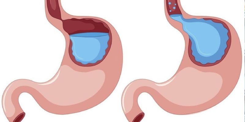 Trào ngược dạ dày là gì?