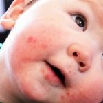 Nước bọt, sữa trào ra ngoài khiến vùng da miệng bị nổi mẩn đỏ