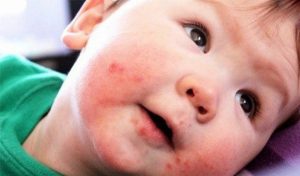 Nước bọt, sữa trào ra ngoài khiến vùng da miệng bị nổi mẩn đỏ