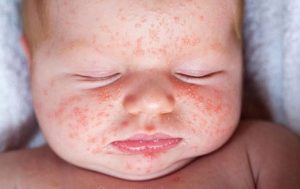 Chàm sữa là một bệnh lý da liễu mãn tính thường gặp ở trẻ sơ sinh và trẻ nhỏ