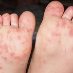 Nổi mẩn đỏ ở chân trẻ sơ sinh là tình trạng thường gặp và có thể do nhiều nguyên nhân gây ra