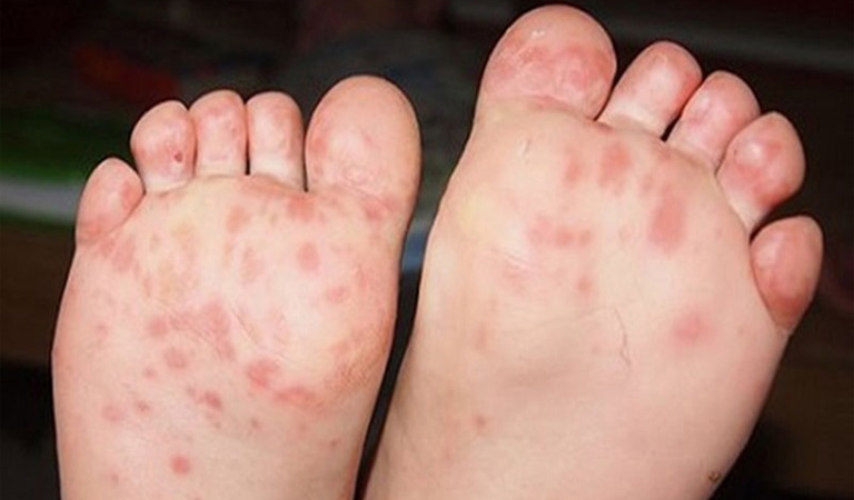 Nổi mẩn đỏ ở chân trẻ sơ sinh là tình trạng thường gặp và có thể do nhiều nguyên nhân gây ra