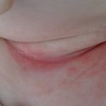 Trẻ sơ sinh bị nổi mẩn đỏ ở cổ là một tình trạng phổ biến, thường thấy ở trẻ trong những tuần và tháng đầu đời