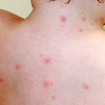 Dị ứng thời tiết là nguyên nhân gây mẩn đỏ cho trẻ