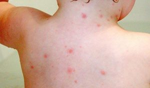 Dị ứng thời tiết là nguyên nhân gây mẩn đỏ cho trẻ