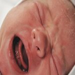 Viêm da tiết bã nhờn khiến da bé nổi mẩn đỏ