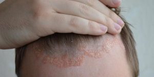 Vảy nến da đầu là gì? Phân loại