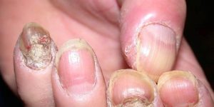 Vảy nến móng tay là bệnh gì?
