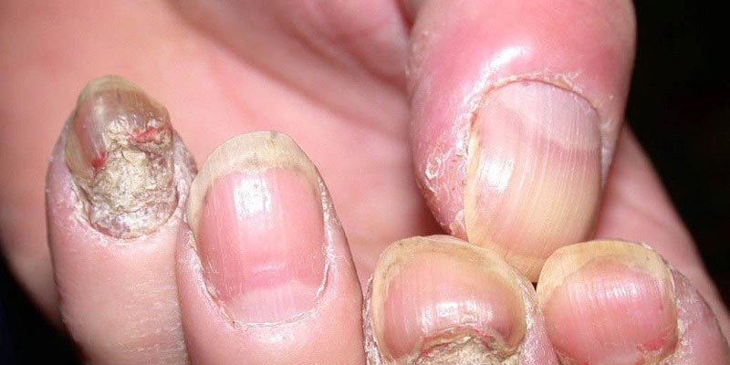 Vảy nến móng tay là bệnh gì?