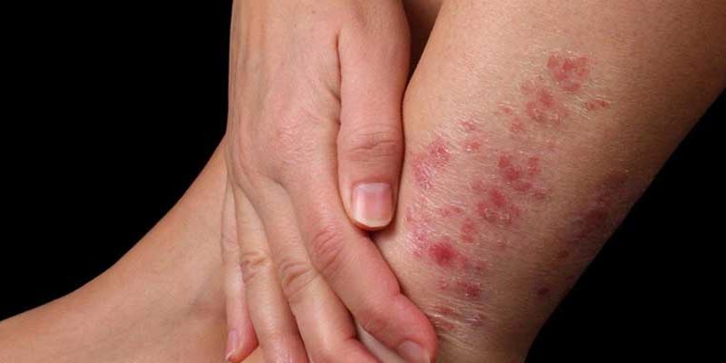 Thông tin về bệnh vảy nến