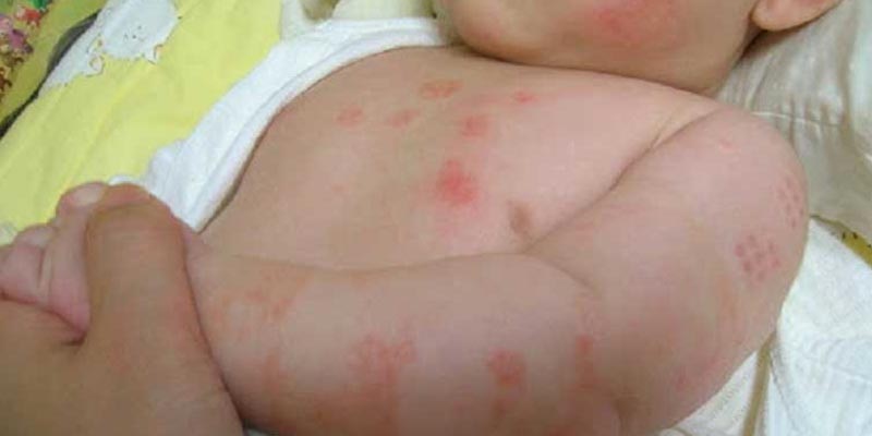 Triệu chứng vẩy nến ở trẻ em