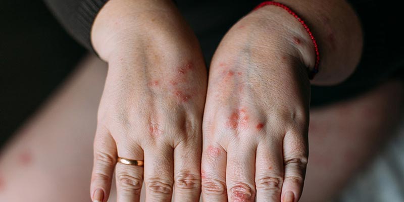 Bệnh viêm da cơ địa đối xứng là gì?