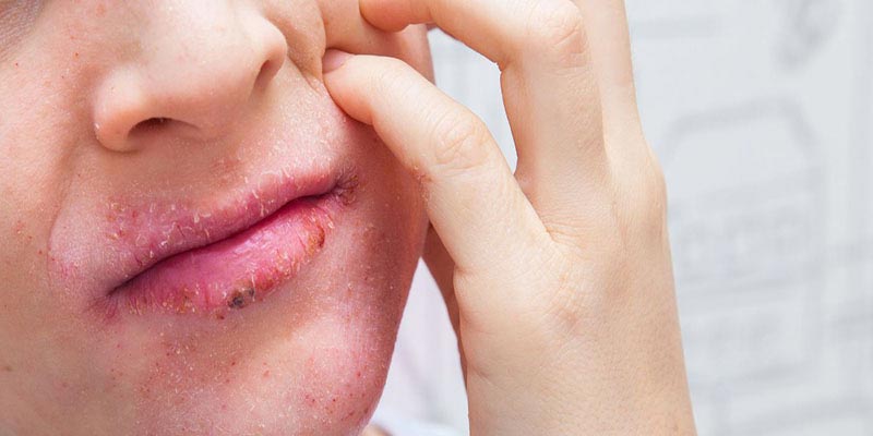 Viêm da cơ địa ở mặt, môi là bệnh gì?