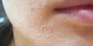 Biểu hiện bệnh viêm da dầu