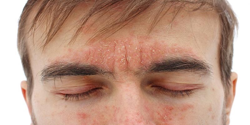 Viêm da dầu ở cánh mũi & Thông tin cần biết