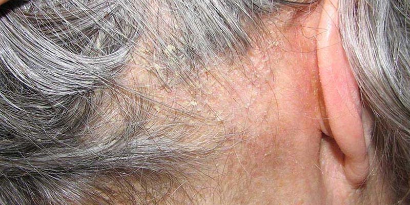 Viêm da dầu ở đầu là bệnh gì?