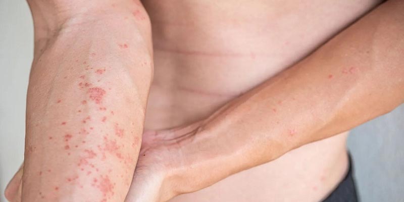 Bệnh viêm da dị ứng bao lâu thì khỏi?
