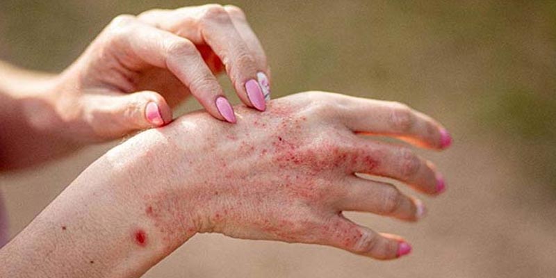 Bệnh viêm da dị ứng có để lại sẹo không?