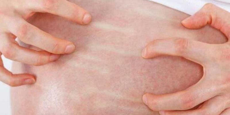 Viêm da dị ứng ở bà bầu là gì?