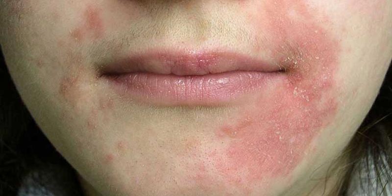 Viêm da dị ứng ở mặt là gì?