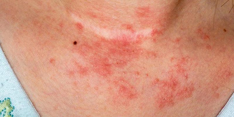 Viêm da dị ứng là gì?