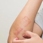 Viêm da tiếp xúc là gì? Các dạng bệnh thường gặp