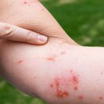 Viêm da tiếp xúc bội nhiễm là gì?