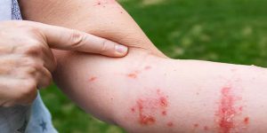 Viêm da tiếp xúc bội nhiễm là gì?