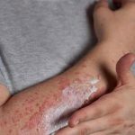 Viêm da dị ứng tiếp xúc có lây không?