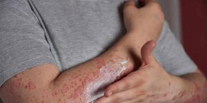 Viêm da dị ứng tiếp xúc có lây không?