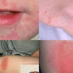 Viêm da tiếp xúc ở trẻ em là gì?