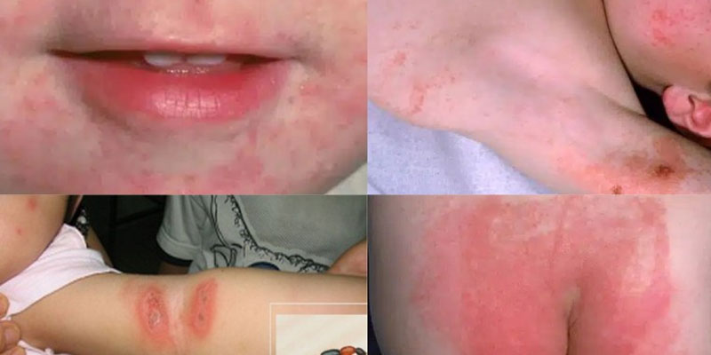Viêm da tiếp xúc ở trẻ em là gì?