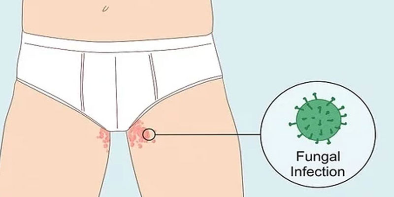 Viêm da tiếp xúc ở vùng kín có dấu hiệu gì?