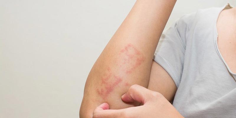 Viêm da tiếp xúc là gì? Các dạng bệnh thường gặp