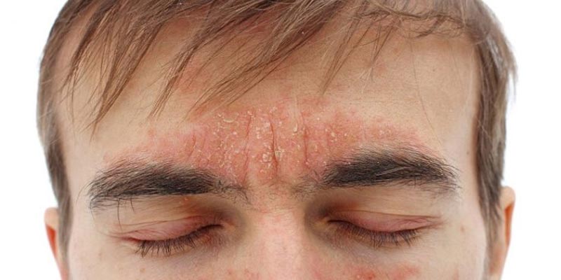 Viêm da tiết bã có lây không? - Giải đáp thắc mắc