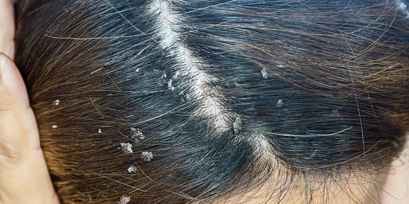 Viêm da tiết bã da đầu là gì?