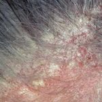 Viêm da tiết bã gây rụng tóc do đâu?