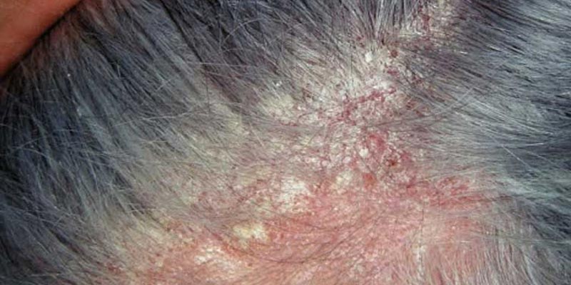 Viêm da tiết bã gây rụng tóc do đâu?