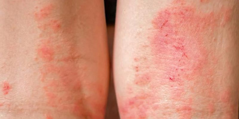 Viêm da là gì? Phân loại cụ thể
