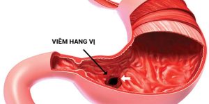 Viêm hang vị dạ dày là gì? Phân loại bệnh