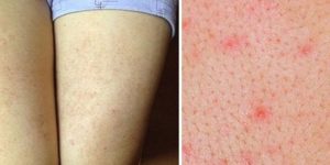 Viêm lỗ chân lông là gì?