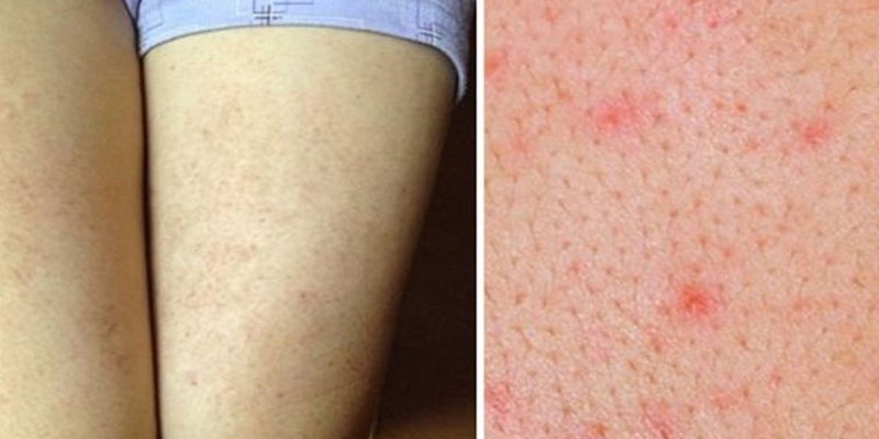 Viêm lỗ chân lông là gì?