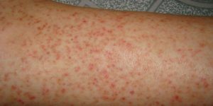 Viêm lỗ chân lông ở tay là gì?
