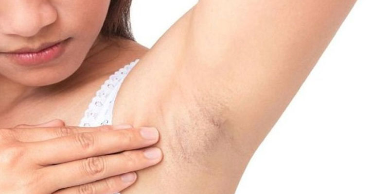 Triệu chứng viêm nang lông nách