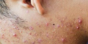 Viêm lỗ chân lông ở mặt là như thế nào?