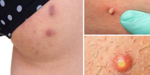 hiệu nhận biết viêm nang lông ở mông