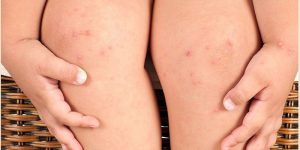 Viêm nang lông ở trẻ em là gì?