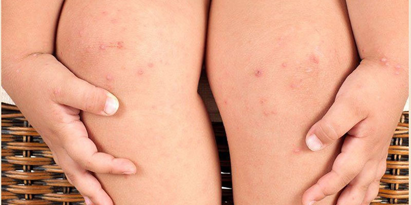 Viêm nang lông ở trẻ em là gì?
